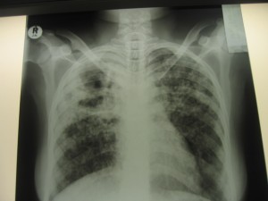 Chest Xray with TB